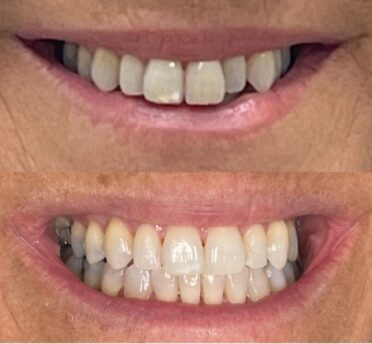 Invisalign case 1