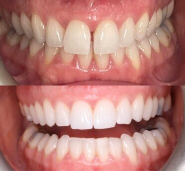 Invisalign case 2