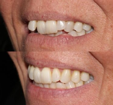 Invisalign case 3