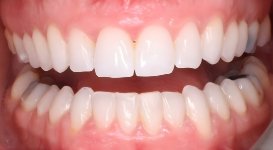 Smile Makeover Case 1 after