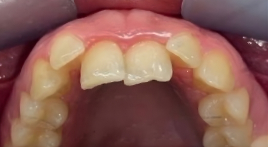 Teeth Straightening Case 1 before