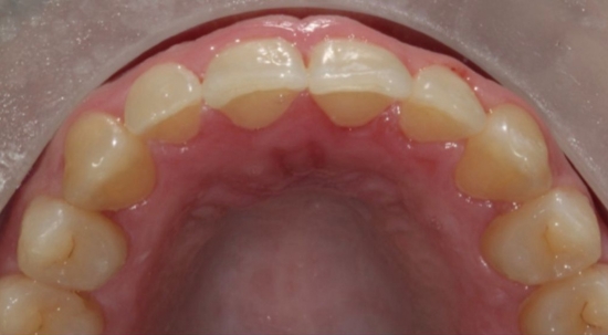 Teeth Straightening Case 1 after