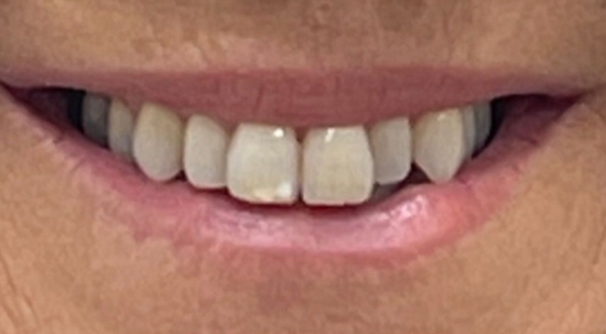 Teeth Straightening Case 2 before