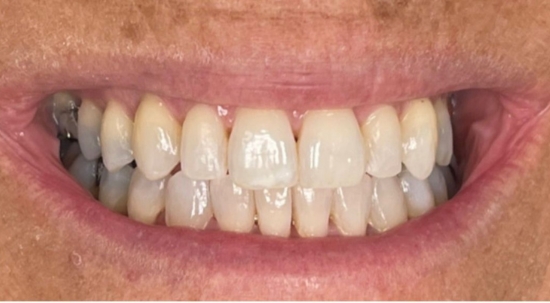 Teeth Straightening Case 2 after