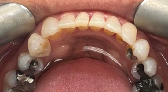 Teeth Straightening Case 4 after