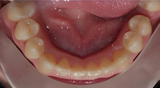 Teeth Straightening Case 5 after