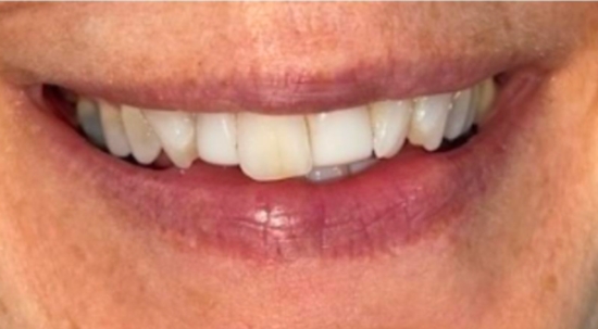 Smile Makeover Case 2 before