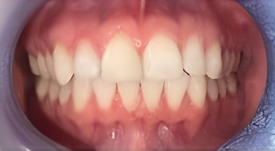 Teeth Straightening Case 6 after