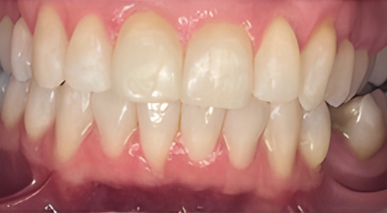 Teeth Straightening Case 7 after