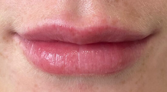 Facial Aesthetics Case 2 after